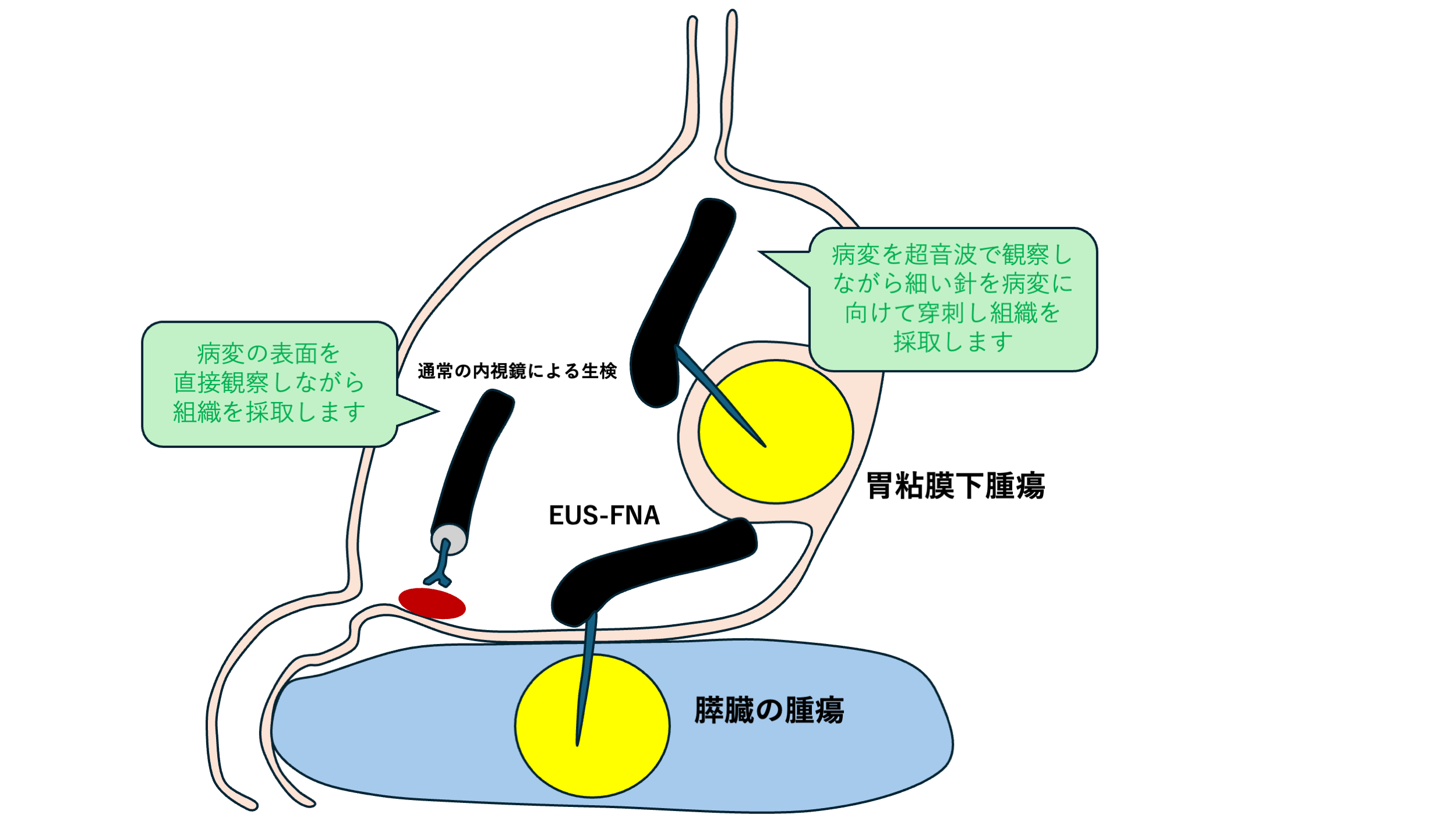 EUS-FNA
